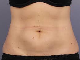 Uncovering a Healthier You with CoolSculpting in Los Angeles